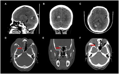 Case report: Beneficial effects of visual cortex tDCS stimulation combined with visual training in patients with visual field defects